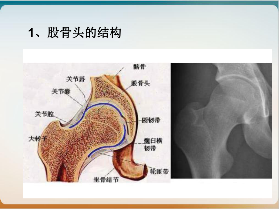 股骨头坏死实用课件.ppt_第3页