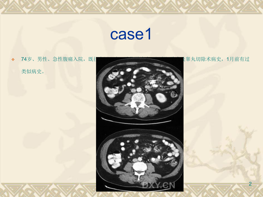 肠系膜病变系列课件.ppt_第2页