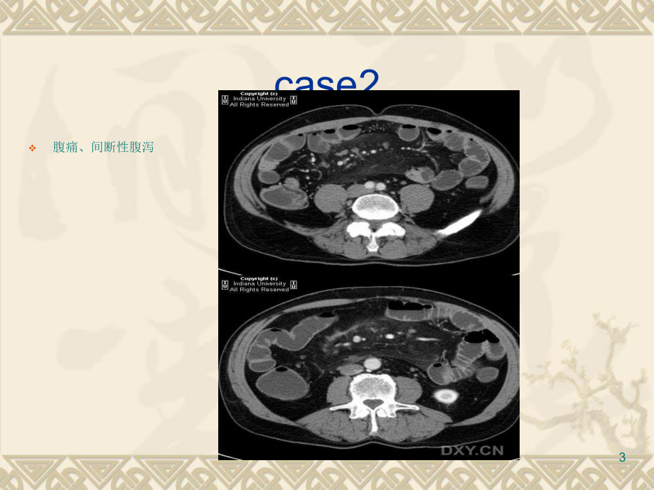 肠系膜病变系列课件.ppt_第3页