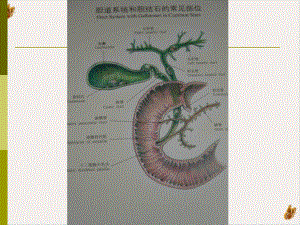 胆囊结石成因和治疗进展教材课件.pptx