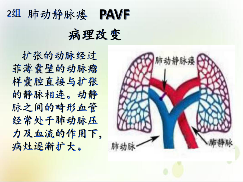 肺动静脉瘘讲课课件.ppt_第3页