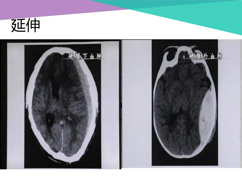 硬膜下血肿清除术课件.ppt_第3页