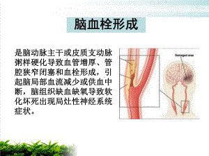 神经病学脑血管病-课件.pptx