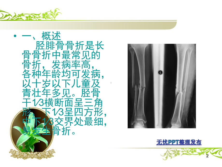 胫腓骨骨折的康复护理课件.ppt_第2页