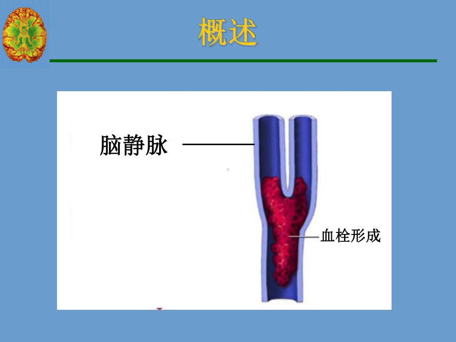 脑静脉系统血栓形成(同名165)课件.ppt_第3页