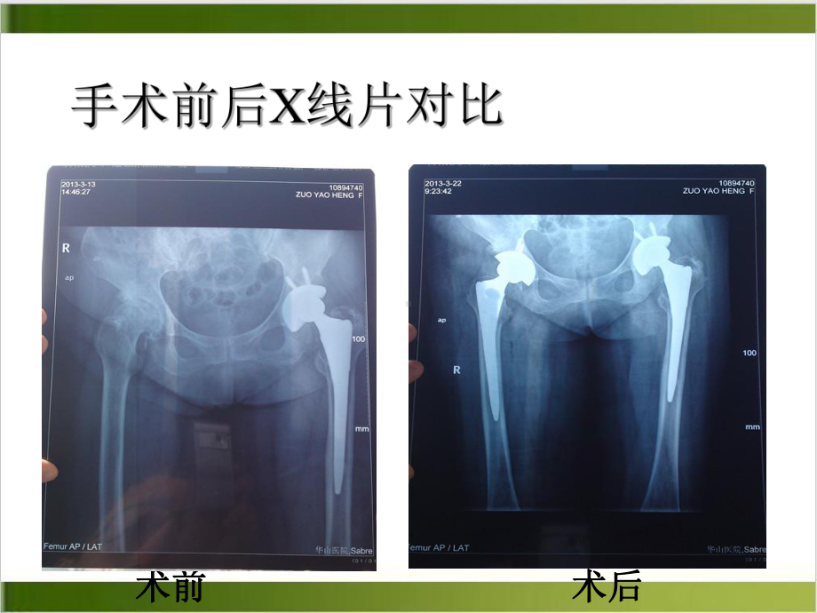 股骨颈骨折全髋关节置换本体感觉缺失康复治疗课件案例.ppt_第3页