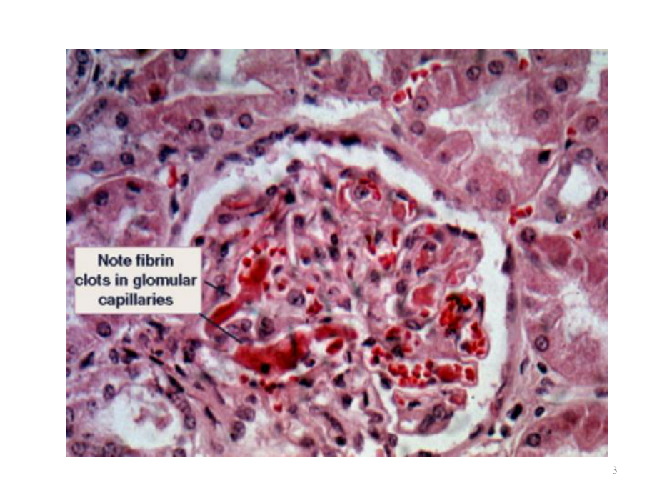 病理学-病理学-第12章-DIC课件.ppt_第3页