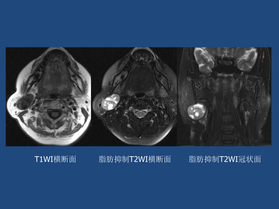 腮腺基底细胞腺瘤全国口腔病例讨论课件.ppt_第3页