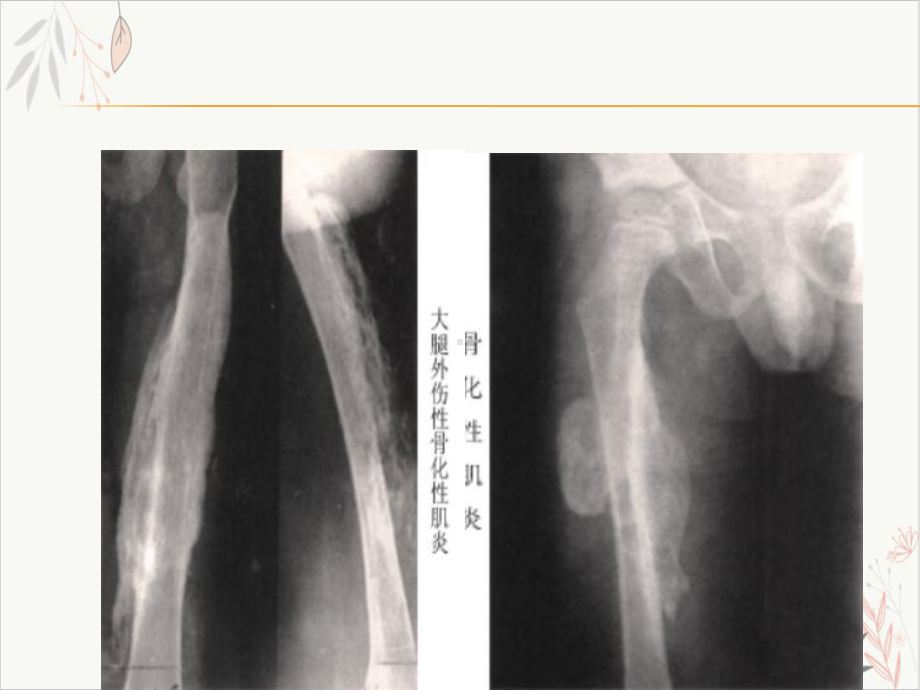 骨化性肌炎探讨课件.pptx_第1页