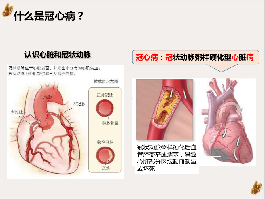 防治高血压冠心病保护好您身体的发动机患教vPPT课件.pptx_第2页