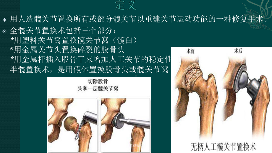 髋关节置换术后的护理课件.pptx_第3页