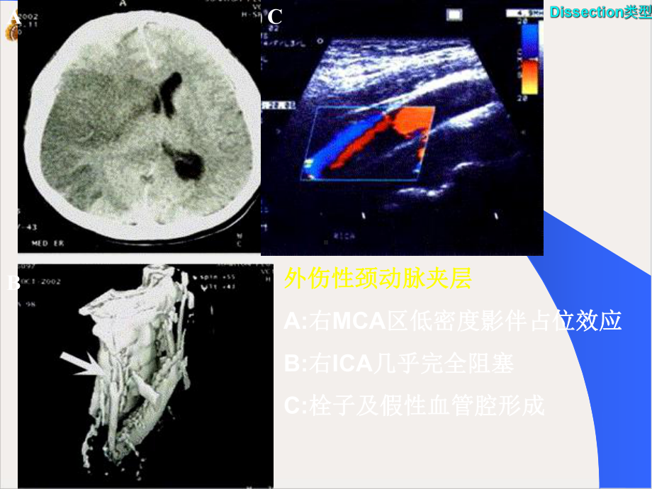 颈动脉和椎基动脉夹层综合征培训课件.pptx_第2页