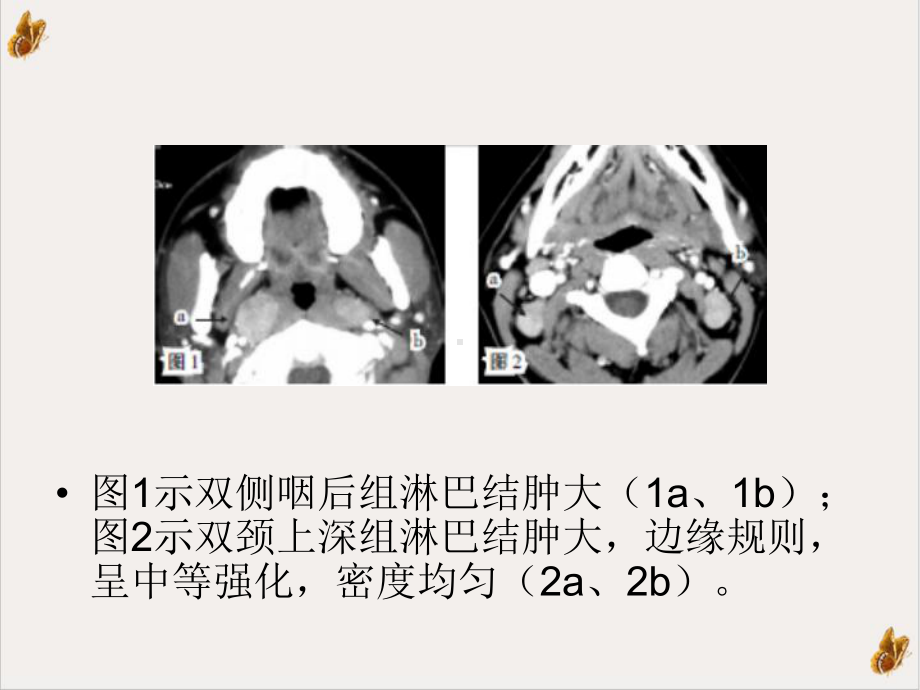 颈部淋巴结转移面面观课件.pptx_第3页