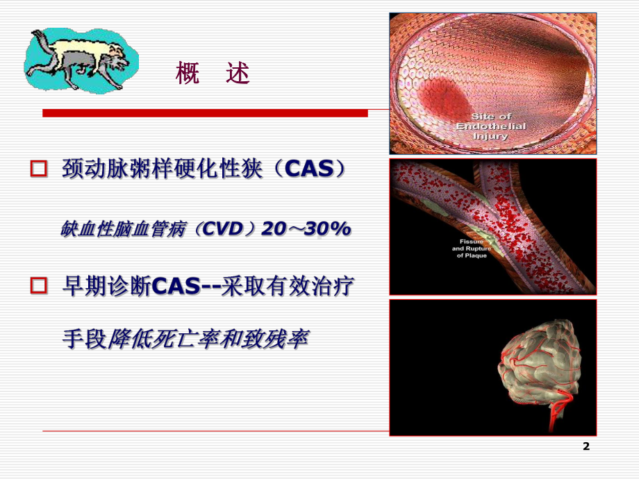 颈动脉狭窄闭塞病因学和超声检测课件.ppt_第2页