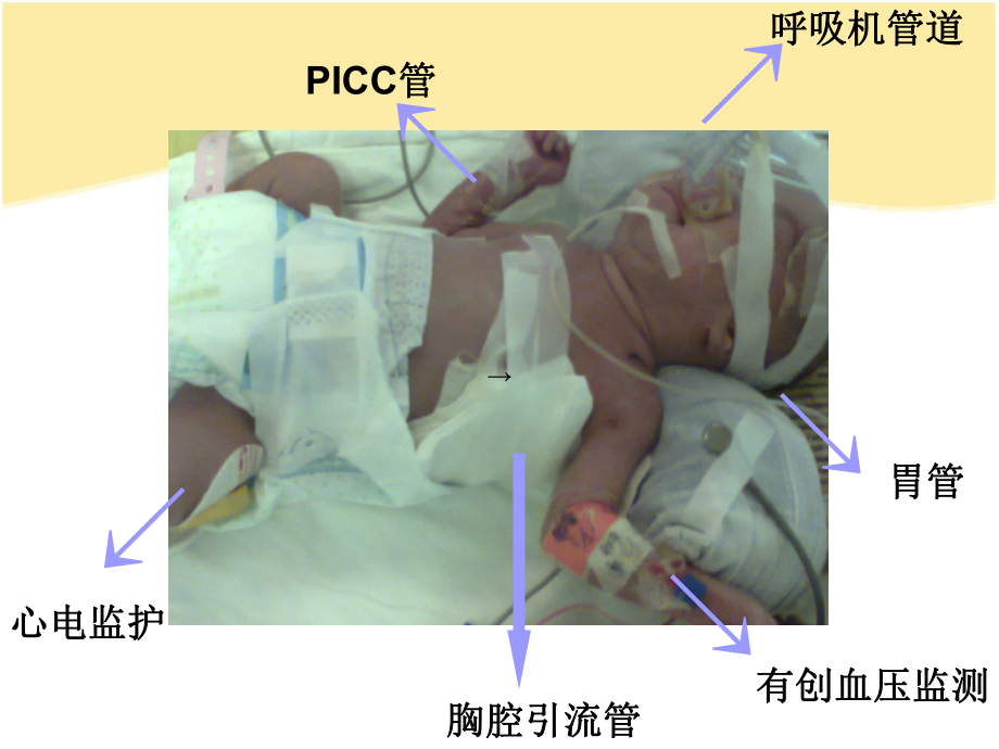 早产儿PDA的护理修改版最终版课件.ppt_第2页