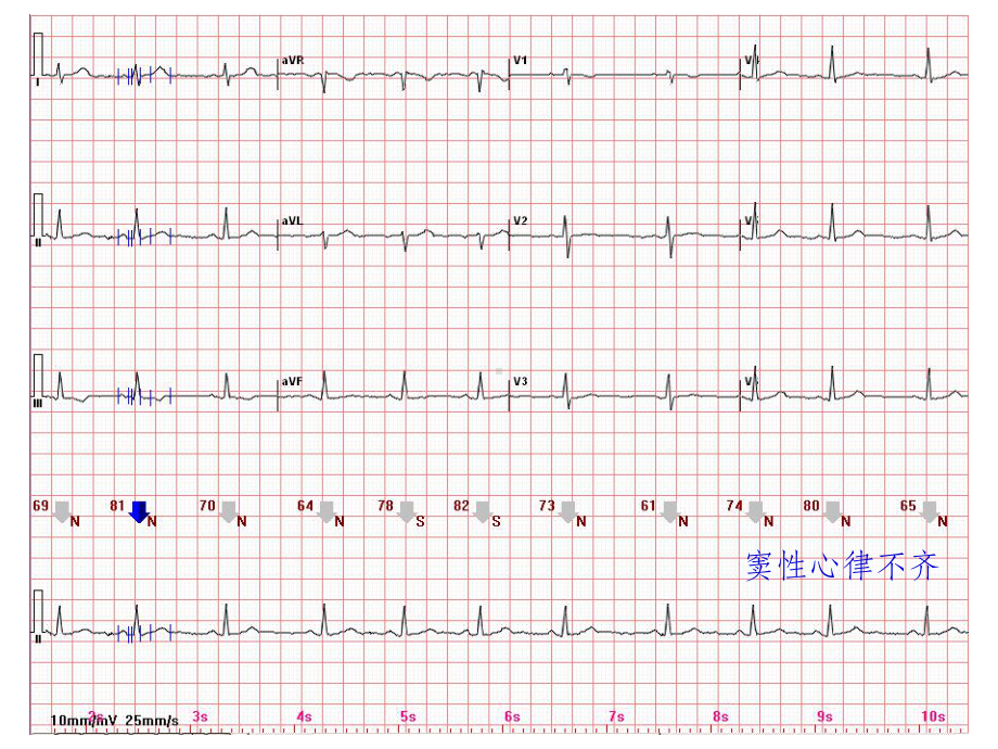 心电图常见正常和异常心电图图谱课件.ppt_第3页