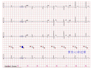 心电图常见正常和异常心电图图谱课件.ppt