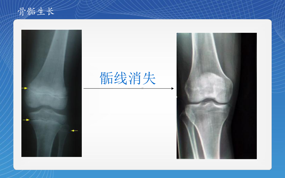 骨骺损伤分型课件.pptx_第3页