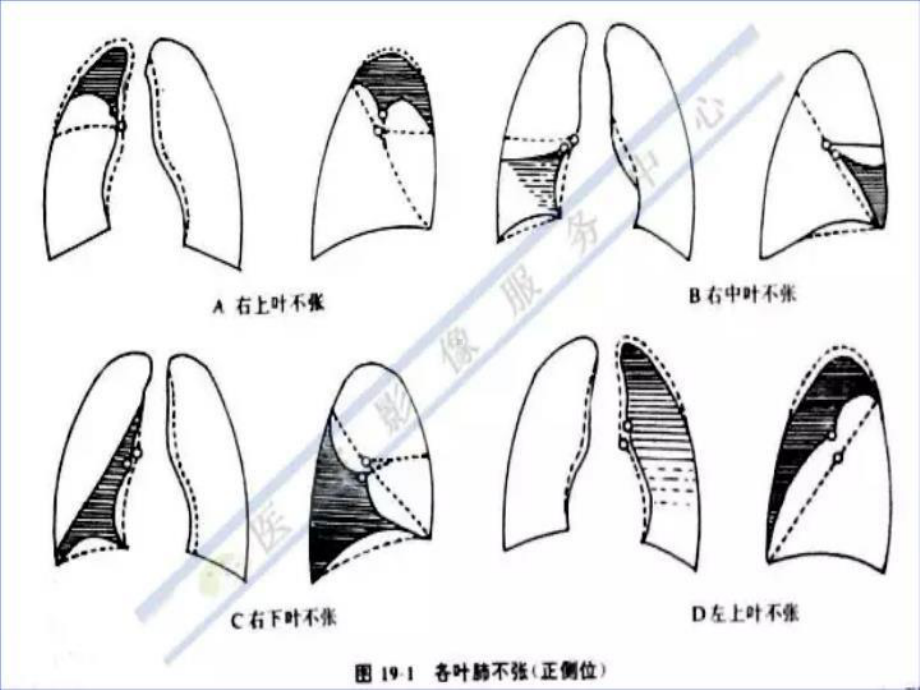 最新不同部位肺不张的影像特点课件.ppt_第3页