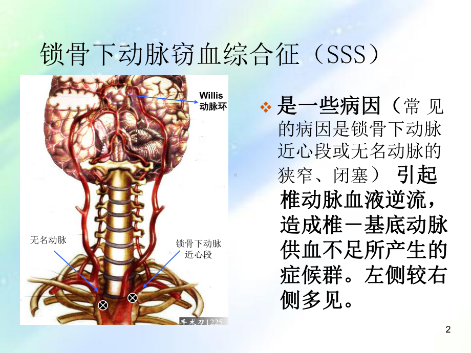 锁骨下动脉盗血综合症图解-课件.ppt_第2页