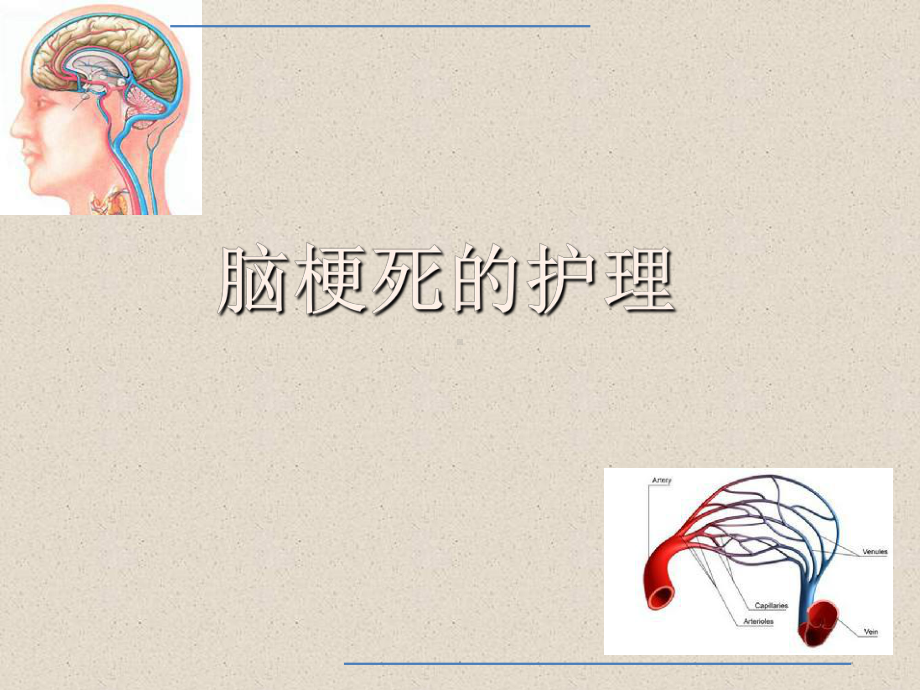 《脑梗死的护理》课件.ppt_第1页