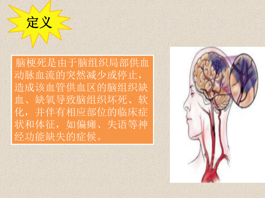 《脑梗死的护理》课件.ppt_第2页