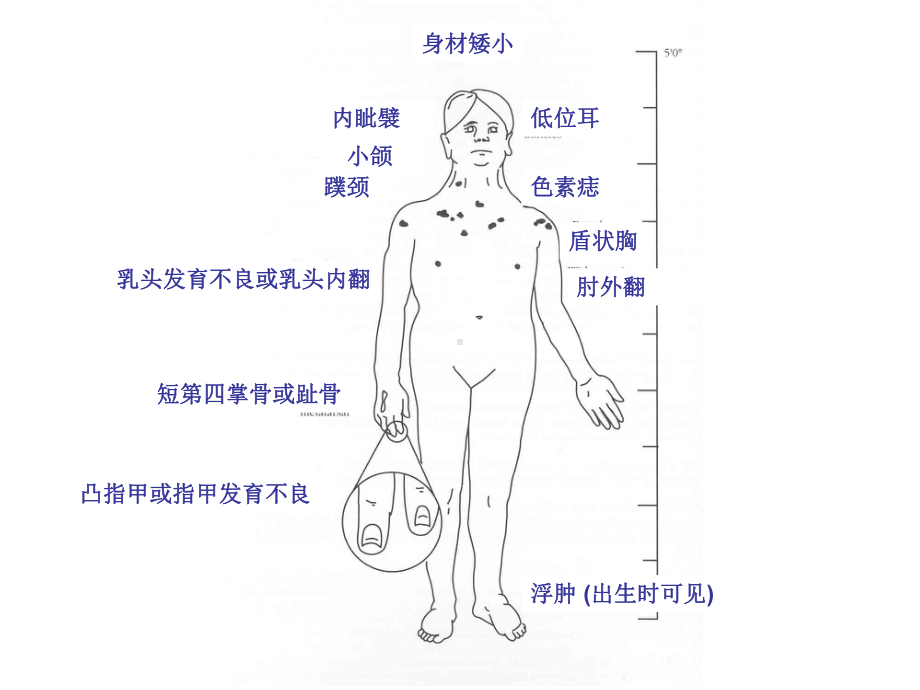 Turner综合症女孩和妇女的诊断与治疗(同名470)课件.ppt_第3页