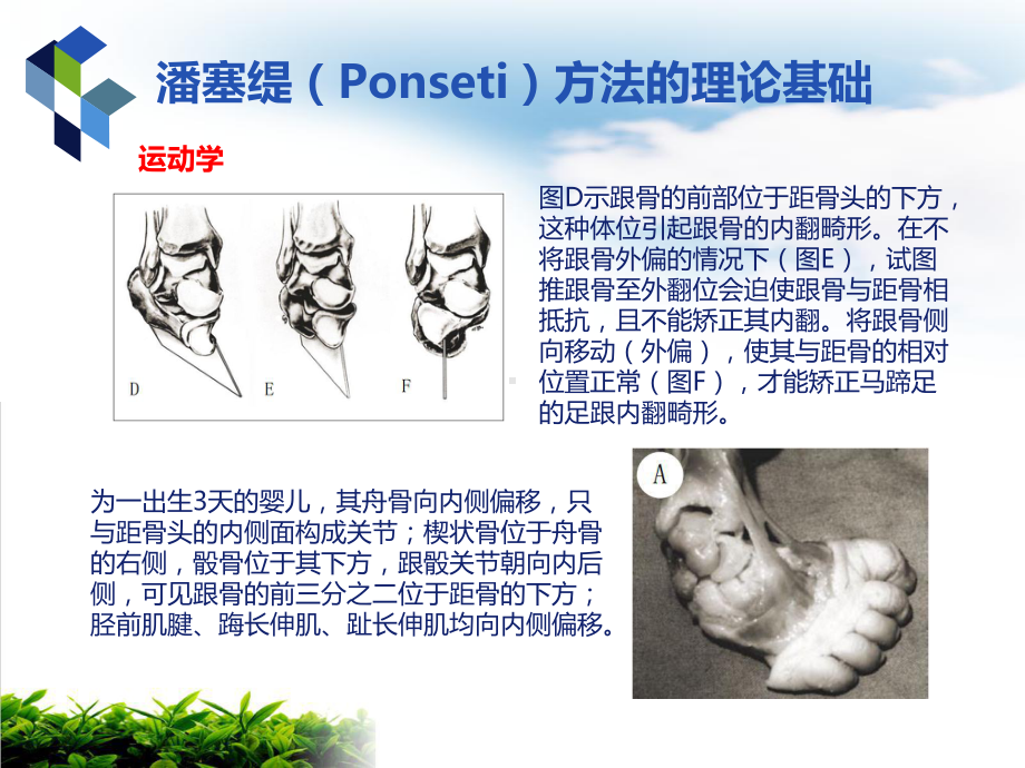 马蹄内翻足治疗法课件.pptx_第3页