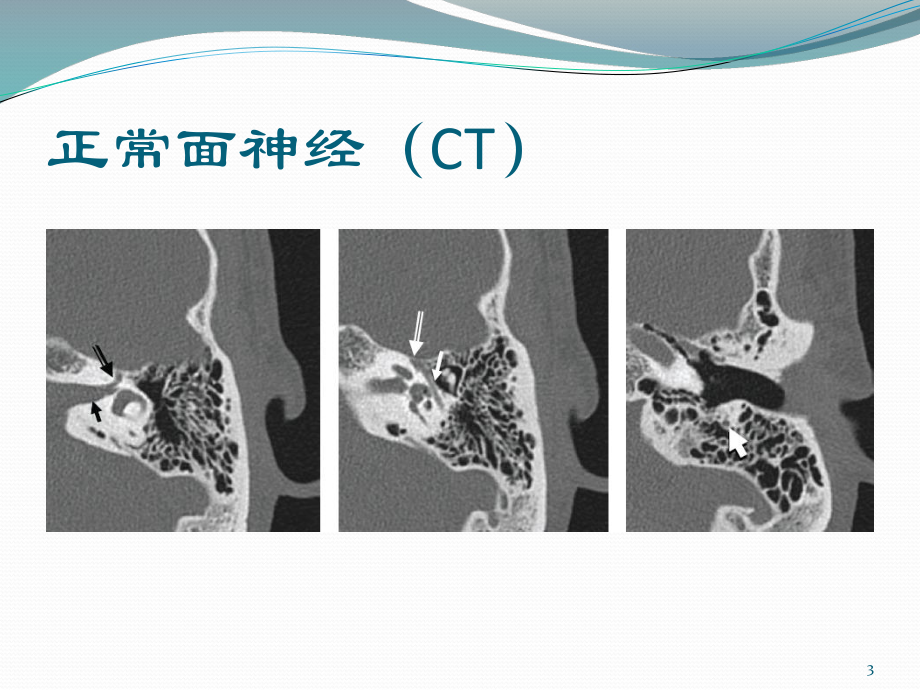 面神经解剖及病变课件.pptx_第3页