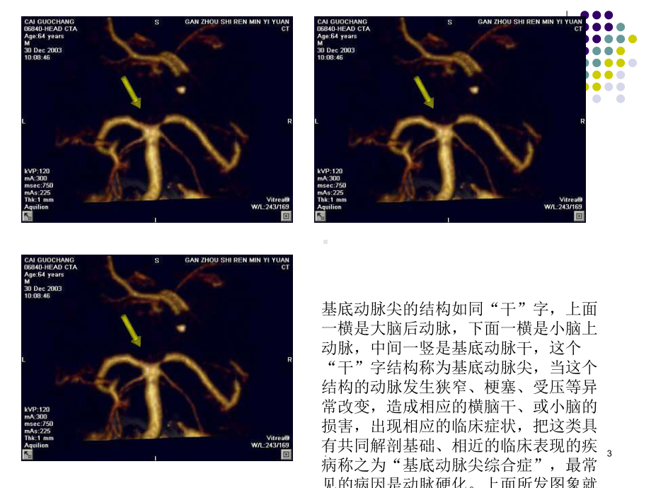 基底动脉尖课件.ppt_第3页