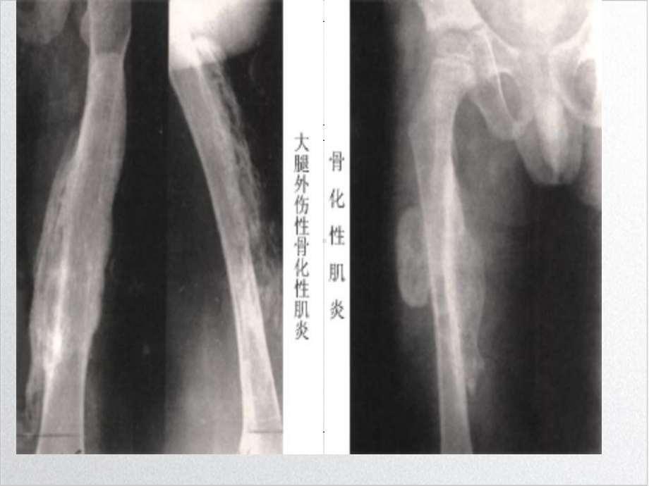 骨化性肌炎培训课件.ppt_第3页