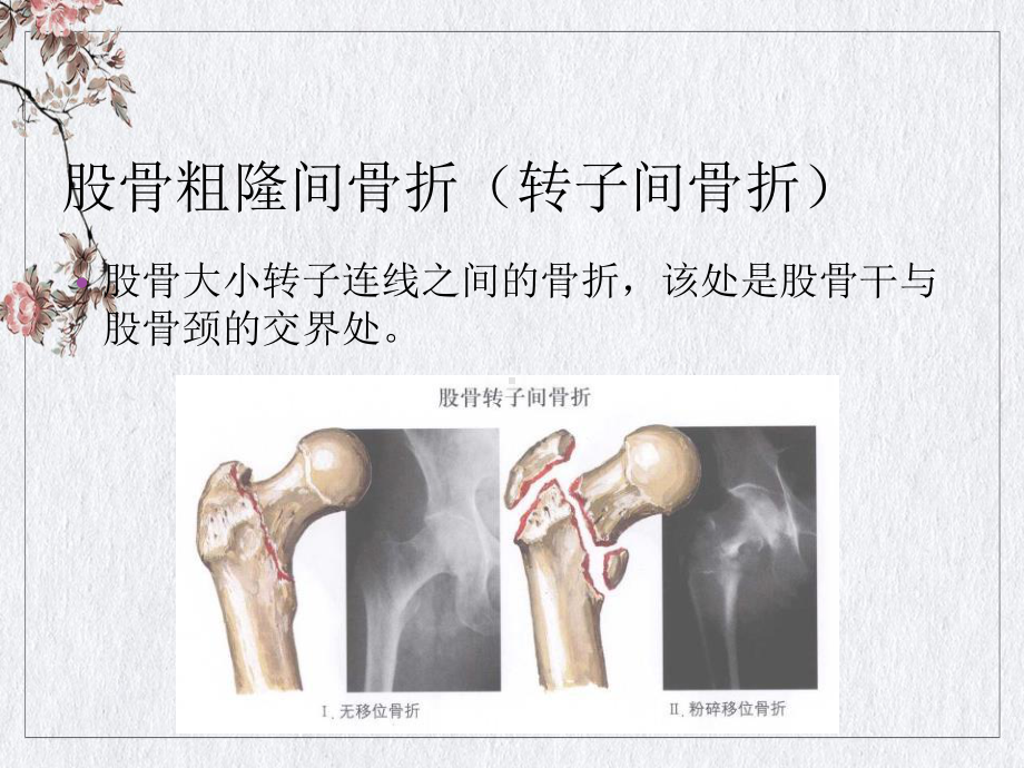 骨骼概述及骨科常见疾病授课课件.ppt_第3页