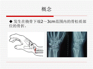 桡骨远端骨折三课件.ppt