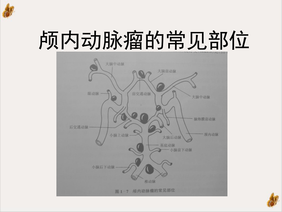 颅内动脉瘤的血管内治疗培训教材课件.ppt_第3页