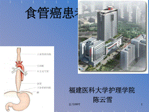 本科食道癌病人的护理课件.ppt