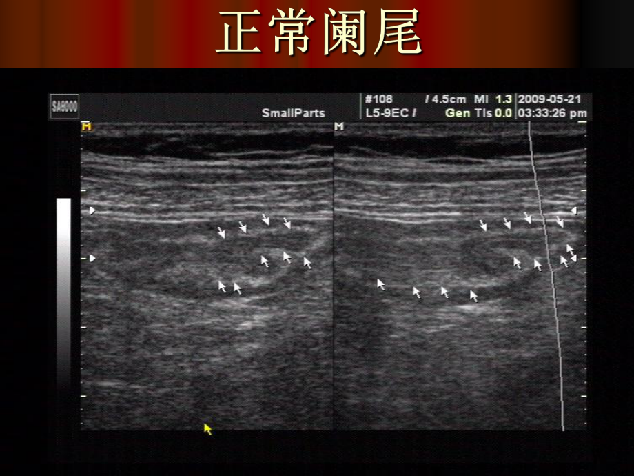 阑尾炎的诊断讲课课件.pptx_第2页