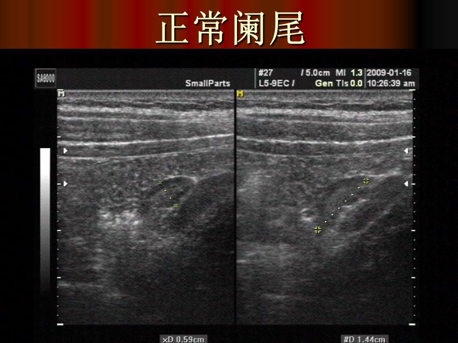 阑尾炎的诊断讲课课件.pptx_第3页