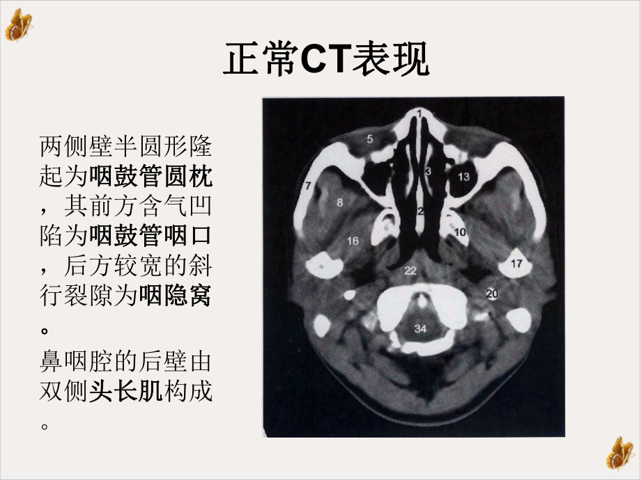 鼻咽部纤维血管瘤课件.ppt_第3页