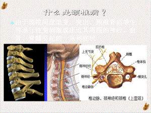 颈椎病分型及治疗培训课程课件.pptx