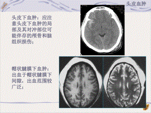 颅脑外伤CT课件.pptx