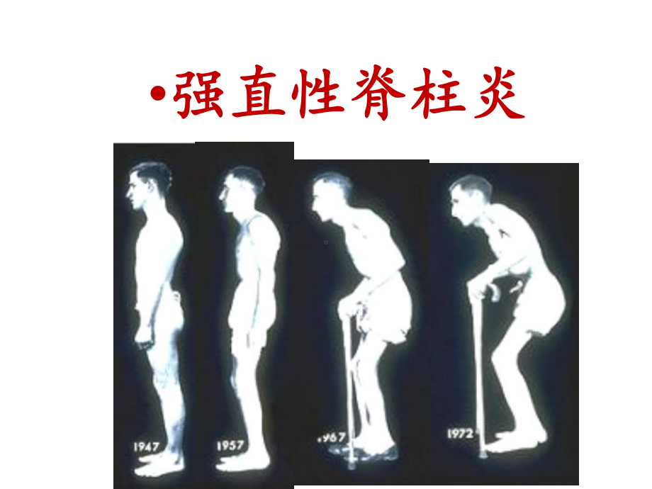 强直性脊柱炎影像诊断课件(同名284).ppt_第1页