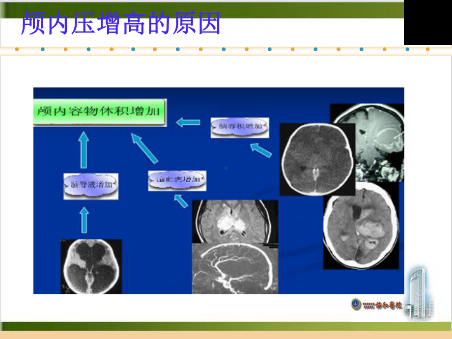 颅内高压护理课件.pptx_第2页