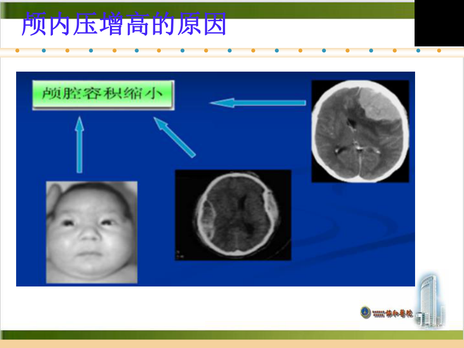 颅内高压护理课件.pptx_第3页