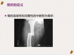 骨折及骨折内固定术后护理实用课件.pptx