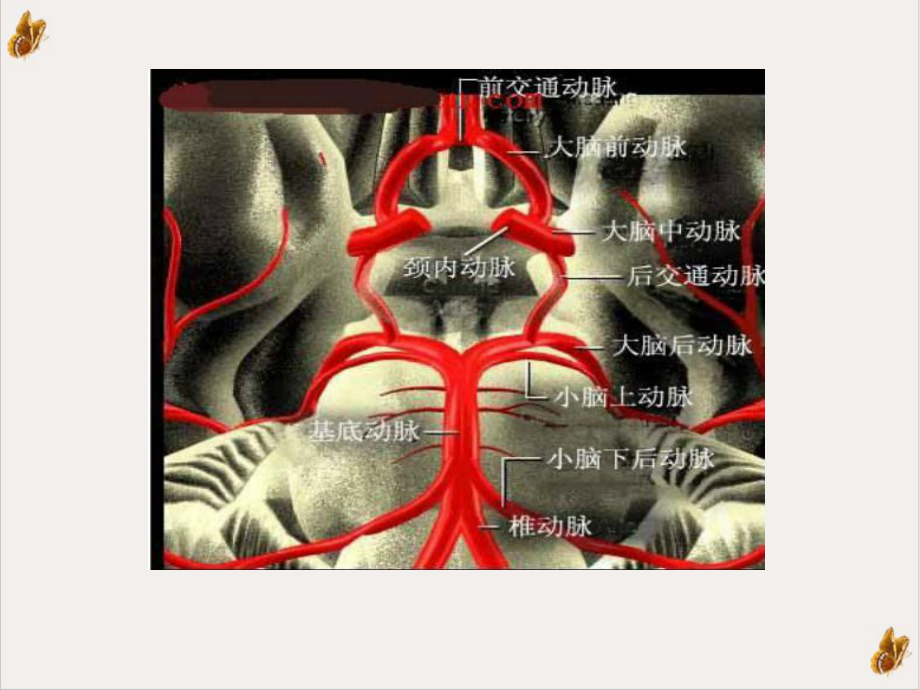 颅内动脉瘤护理查房课件整理.ppt_第3页