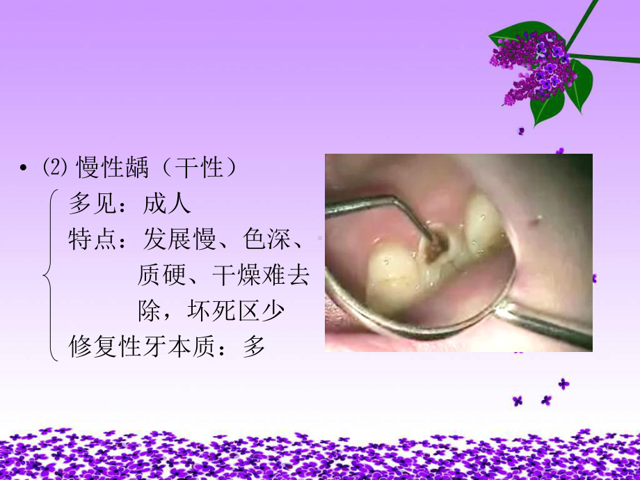 龋病的分类和临床表现课件.ppt_第3页