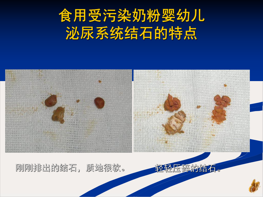 食用受污染奶粉婴幼儿泌尿系统疾病的超声诊断课件.pptx_第2页