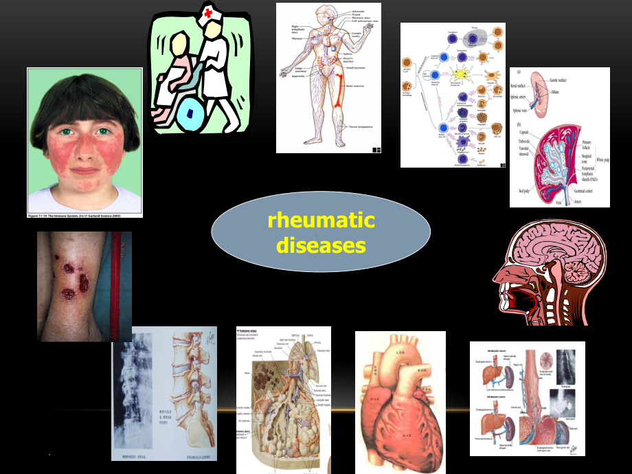 风湿性疾病的实验诊断模板课件.ppt_第2页