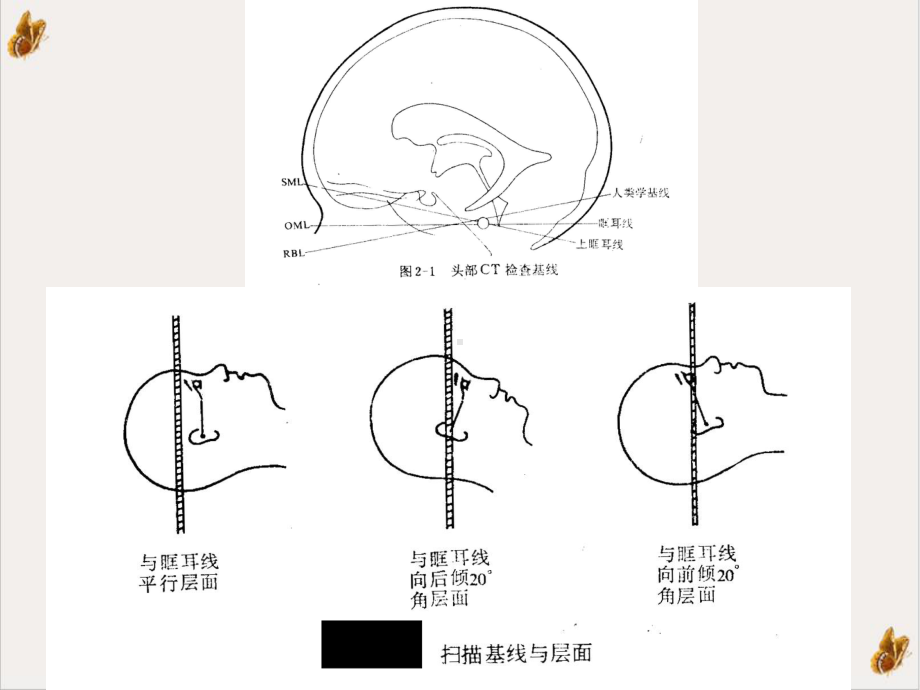 颅脑CT读片技能课件.ppt_第3页