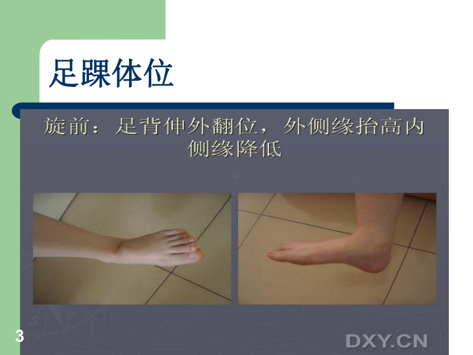 踝关节骨折与脱位的诊治及护理课件.ppt_第3页